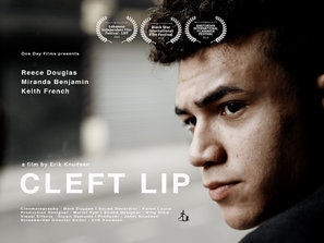 Cleft Lip Canvas Poster